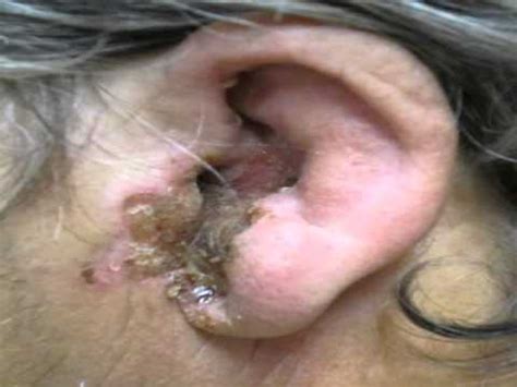 dog ear infection - YouTube
