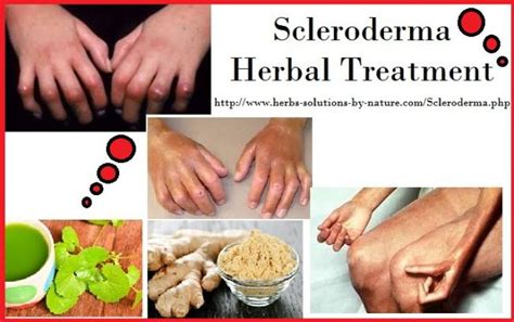 Five Homemade Scleroderma Herbal Treatments Body Tissues, Skin ...