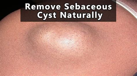 Remove Sebaceous Cyst Naturally at Home (Fast and Easy) | Home remedies for cysts, Home remedies ...