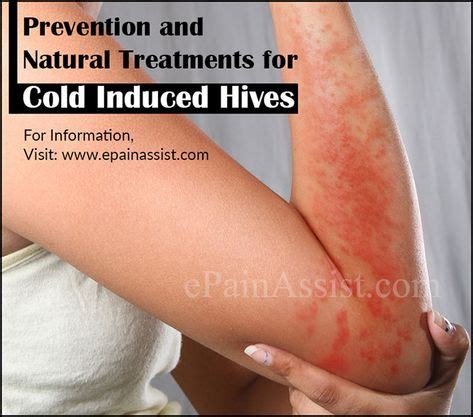 Prevention of Cold Induced Hives or Cold Urticaria Read: http://www ...