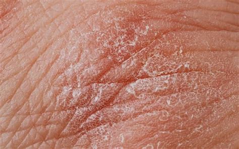 What Causes Dry Patches On Skin And How To Cure At Home?