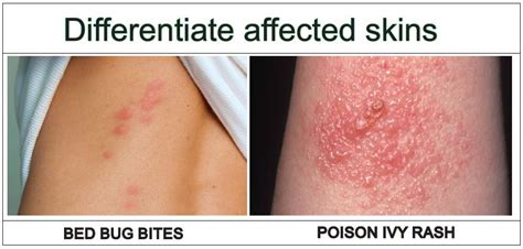 Bed Bug Bite Poison Ivy Rash: VS In 6 Points Explained! | Y-L-P-C