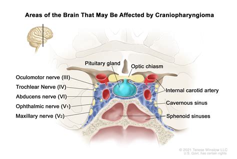 Childhood Craniopharyngioma Treatment (PDQ®) - NCI