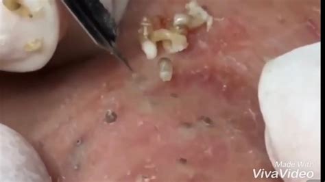 Blackhead Popping Pimple On Back