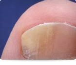 Fungal Nail GP Services in Waterford | Local GP Waterford | The Keogh Practice | Find GP in ...