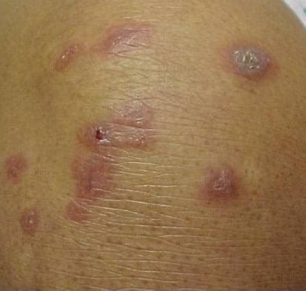 Sarcoidosis (cutaneous sarcoidosis)