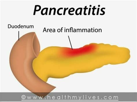 PANCREATITIS - CAUSES, SYMPTOMS, TREATMENTS & PREVENTION