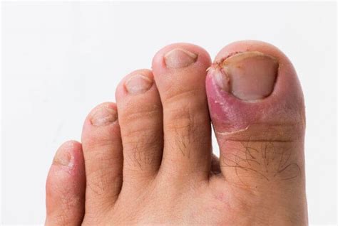 All About Ingrown Toenails - Round House Podiatry