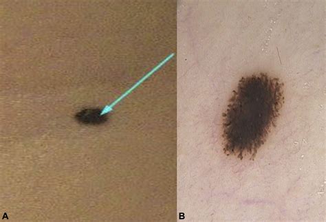 Pediatric pigmented Spitz nevus: A natural course toward involution assessed with dermoscopy ...