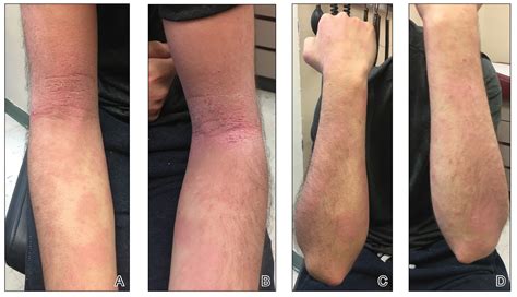 Atopic Dermatitis Triggered by Omalizumab and Treated With Dupilumab | MDedge Dermatology