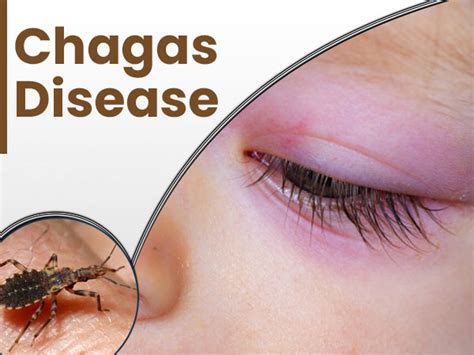 treatment of chagas disease Timeline showing the history of chagas disease treatment. - Diseases ...