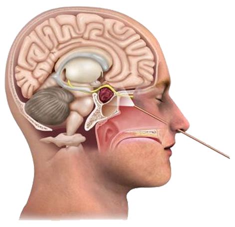 Skull Base & Cranial Base Surgery - IBS Hospital Delhi