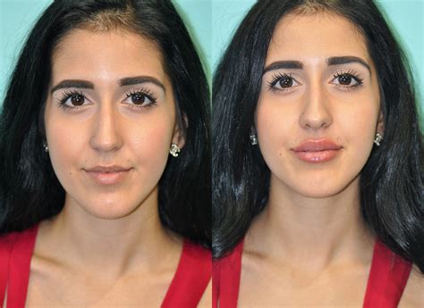 Before And After Photos Of Lip Injections | Sitelip.org