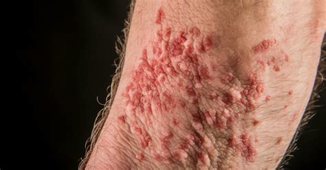 Mold Rash: Causes, Symptoms, And Prevention Tips