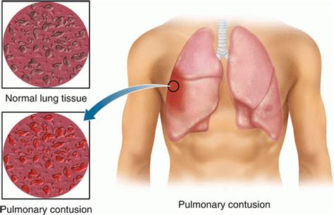 Pulmonary contusion ICD-10, Diagnosis, Recovery, Complications - Health Care Tips and Natural ...