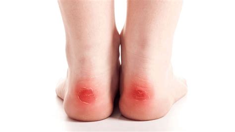 A Blister On My Foot Sale | emergencydentistry.com