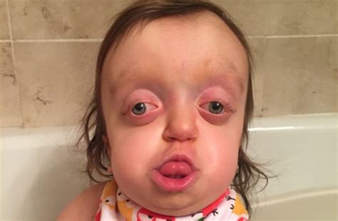 Girl born with severely deformed head smiles despite strangers labelling her 'alien' | Metro News