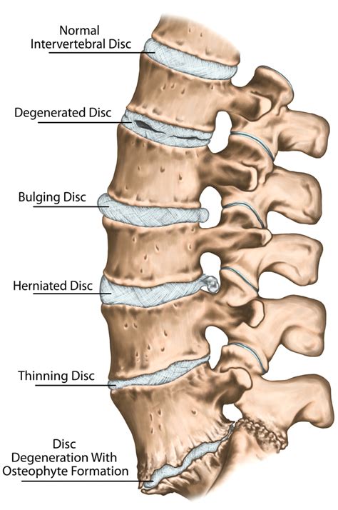 Trapped Nerves: Causes & Treatment | Buxton Osteopathy Clinic