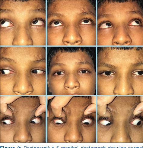 Management of head tilt in infantile nystagmus syndrome: A case report ...