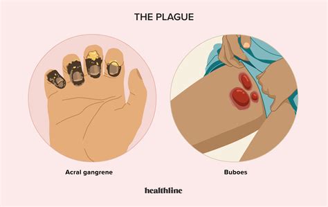 The plague types causes and symptoms – Artofit
