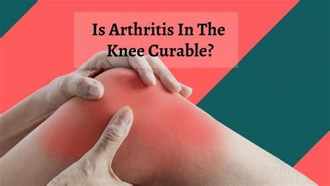 Knee Arthritis Severe Symptoms: Can You Treat Arthritis In Knee? Doctor ...