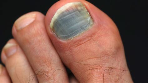 Black Fungus Under Toenail - 7 Effective Toenail Fungus Treatments Best Natural Home Remedies ...