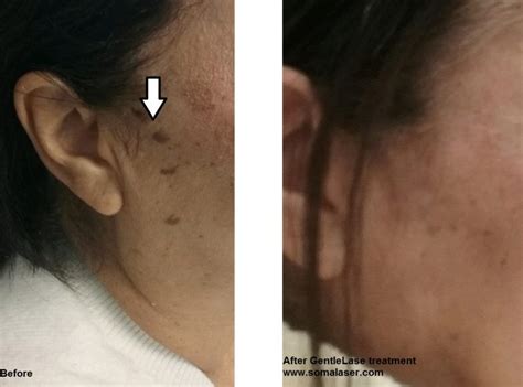 Seborrheic Keratosis Removal in New Jersey | SOMA Skin & Laser