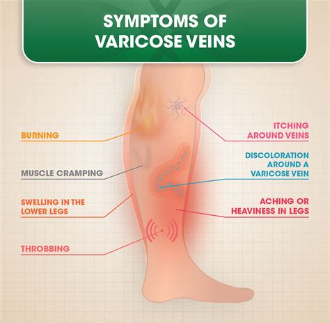 Varicose Veins | DOC Vein Management