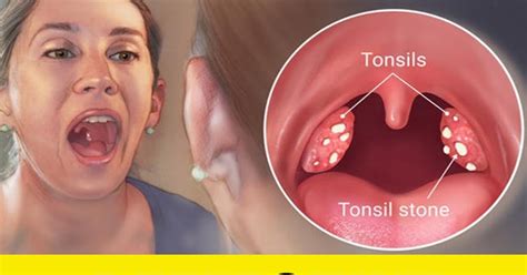 4 EFFECTIVE WAYS TO REMOVE TONSIL STONES WITHOUT SURGERY