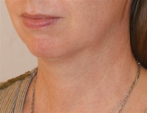 Short Scar Neck Lift Before and After | Dino Elyassnia, MD