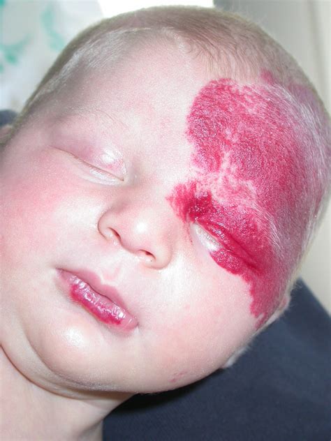 Hemangiomas (infantile hemangiomas, common hemangiomas, strawberry hemangiomas, capillary ...