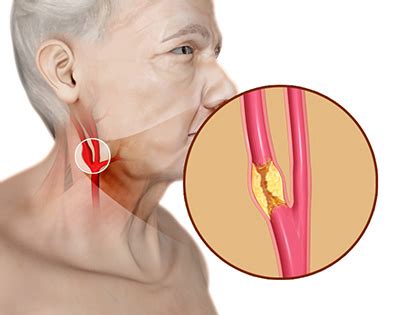 life expectancy with carotid artery disease - Brandie Duval