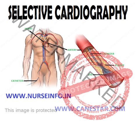 SELECTIVE CARDIOGRAPHY - Nurse Info