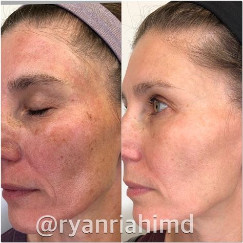 Intense Pulsed Light (IPL) Before & After Photos Patient 48 | Houston, TX | DermSurgery Associates