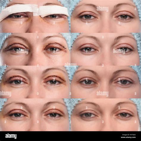 Blepharoplasty of the upper eyelid Stock Photo - Alamy