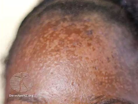 What Seborrheic Dermatitis Looks Like on Black Skin | MySebDermTeam