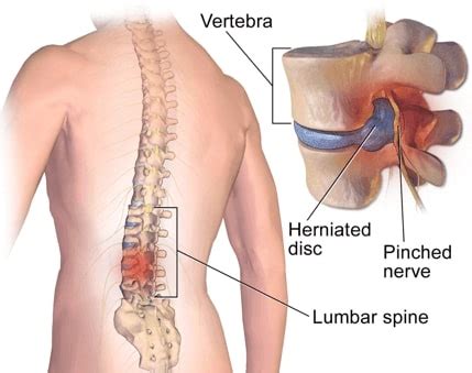 Low Back Pain Treatment Doctors in NJ: Edison, Union, Bayonne, Paterson ...