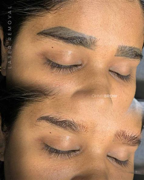 PMU LASER REMOVAL ONLINE THEORY — OHMYBROW