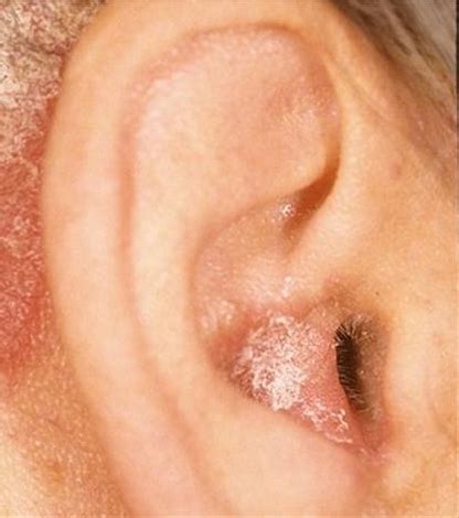 Earwax impaction