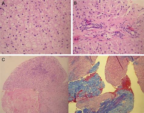 Focal nodular hyperplasia: A diagnosis to consider in a hepatic mass | Anales de Pediatría ...