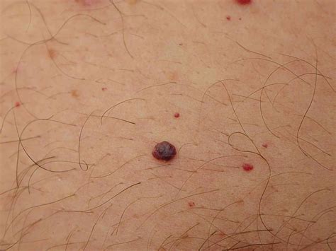 Common lumps and bumps on and under the skin: what are they?