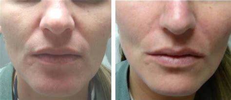 Deep Wrinkle Fillers And Facial Contouring At Schweiger Dermatology