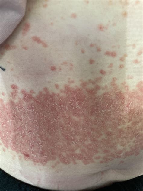 Help rash identification : r/DermatologyQuestions