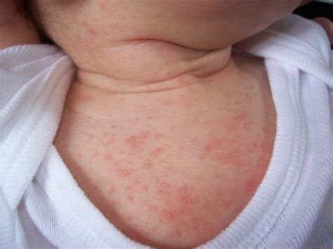 Figure 1. Erythema Toxicum Neonatorum | Baby acne treatment, Baby acne ...