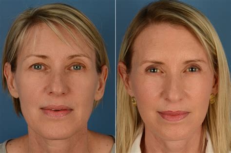 The UpLift™ Lower Face and Neck Lift Photos | Naples, FL | Patient 16233