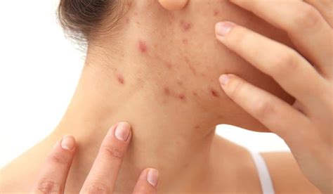 Acne During Pregnancy: Causes, Home Remedies & Treatment