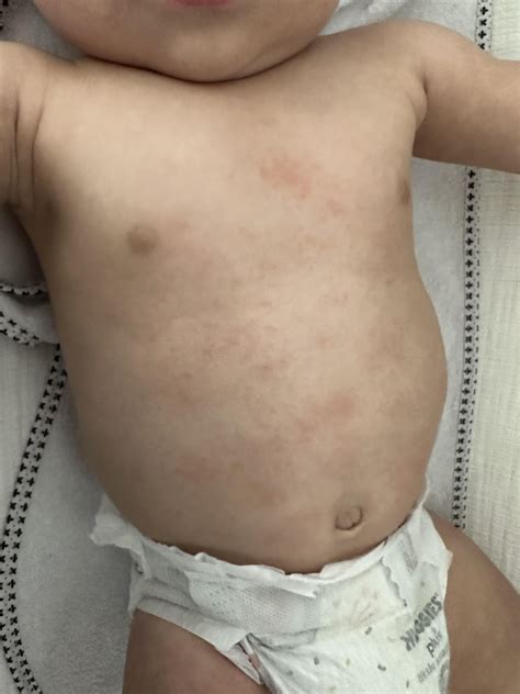 Rash? Eczema? Milk allergy?? : r/newborns