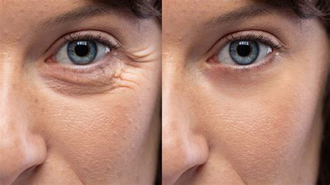 Botox Brow Lift: What Is It & How Does It Work?