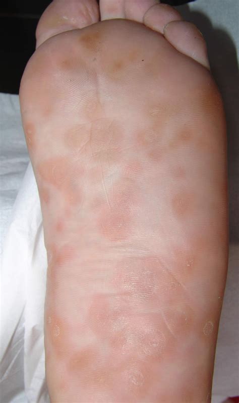 Syphilis Rash Stages