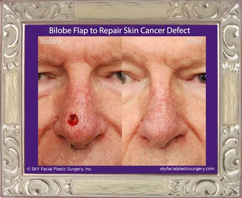 Nasal Skin Cancer Reconstruction - vrogue.co